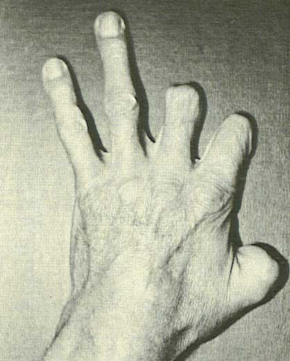 In his 1978 autobiography, John published this photo of the hand injured in 1918 and that he refused to let deter a promising piping career.